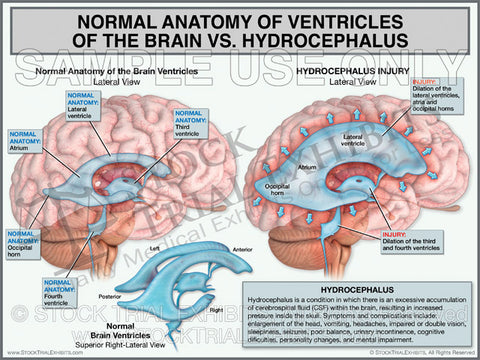 Normal Ventricles of the Brain vs Hydrocephalus Brain Injury