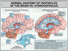 Brain Injury - Hydrocephalus
