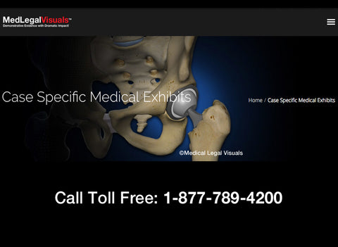 Case Specific Medical Exhibits for Personal Injury and Medical Malpractice Cases