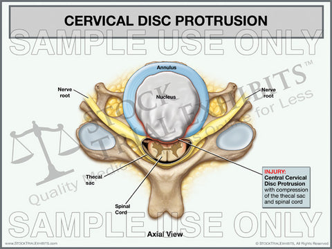 Cervical Disc Protrusion and Disc Herniation