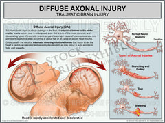 Diffuse Axonal Injury - Traumatic Brain Injury Exhibits