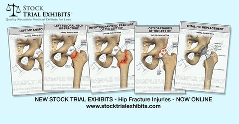 Stock Exhibits for Personal Injury Cases - Hip Fracture Injuries