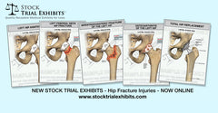 Femur fractures and Hip fractures Stock Medical Exhibits and Medical Legal Illustrations