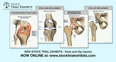 Knee and Hip Osteoarthritis and Total Knee and Hip Arthroplasty Medical Exhibits