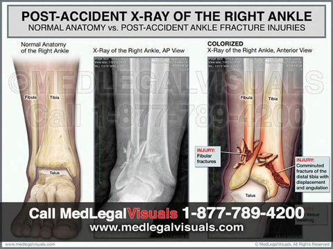 Medical illustration for presenting ankle fracture injuries