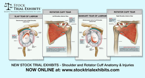 Rotator Cuff Tear and Labrum Tear Injuries - New Stock Medical Exhibits
