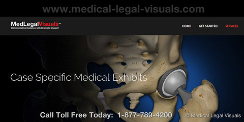 Legal Illustrations from Medical Legal Visuals - Trial Presentation for Personal Injury Cases