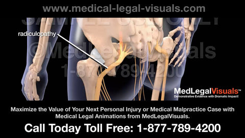Medical Legal Animations - for personal injury and medical malpractice cases