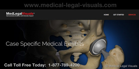 Medical Legal Illustrations case specific medical exhibits