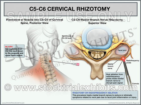 C3-C4 Anterior Cervical Discectomy and Fusion – Stock Trial Exhibits