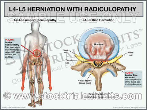 http://cdn.shopify.com/s/files/1/0278/6291/products/L4-L5_HerniationwithRadiculopathy_trialexhibit_large.jpg?v=1547872957