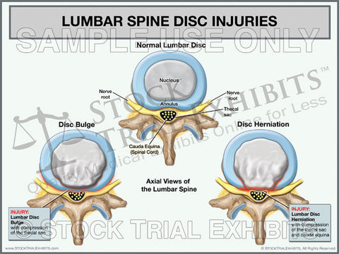 Broad Based Disc Bulge and Herniation - Trial Exhibits for Injury Atto –  Stock Trial Exhibits