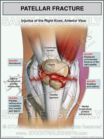 MCL Tear of the Right Knee – Stock Trial Exhibits