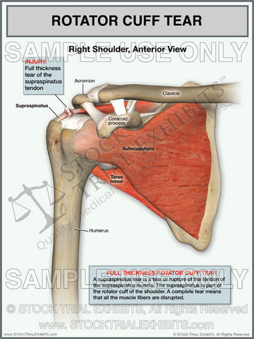 Rotator Cuff Tear and Labrum Tear Injury Medical Exhibits for Settleme –  Stock Trial Exhibits