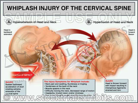 Anatomy of the Cervical Spine - Trial Exhibits Inc.