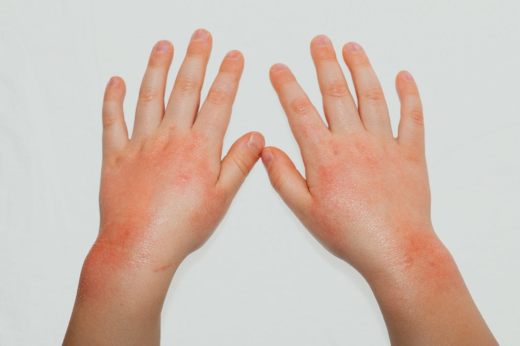 scabies rash on hands