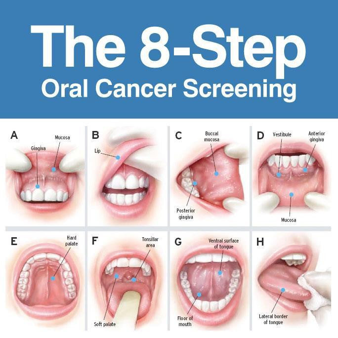 hpv mouth diagnosis