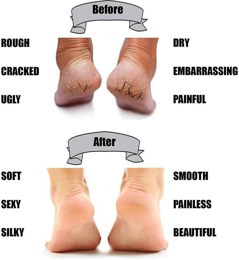 fix rough heels