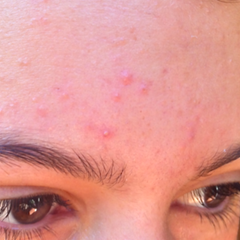 Acne treatments, types, causes and symptoms