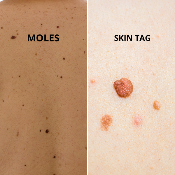 moles-vs-skin-tags-is-there-a-difference-between-them-awd-med