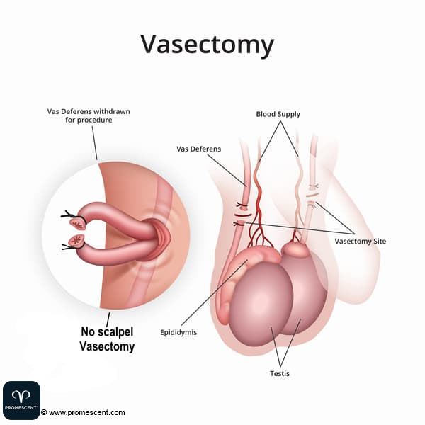 different-vasectomy-procedures