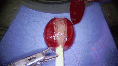 gif-example-vasectomy-surgery