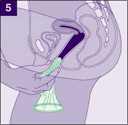 insert the female condom