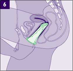 female condom image