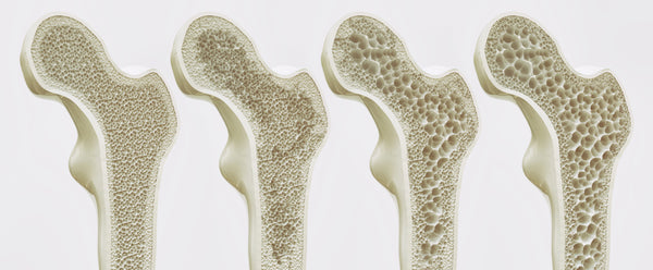 osteoporose sanmagnesium sanomega benskjørhet 