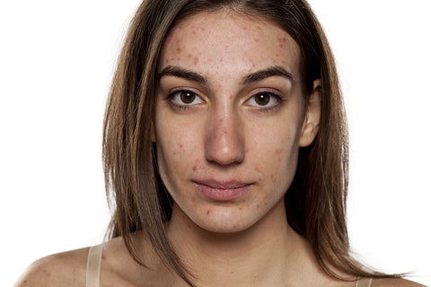 Woman with acne