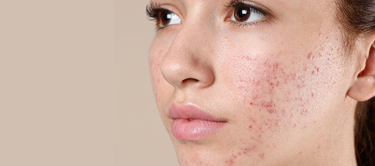 How To Take Care Of Oily Skin And Acne? – Re'equil
