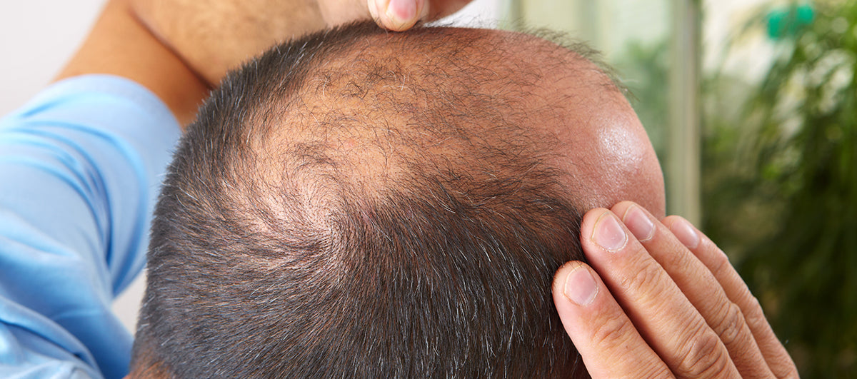 Different Types Of Hair Loss and Ways To Treat Them – Re'equil