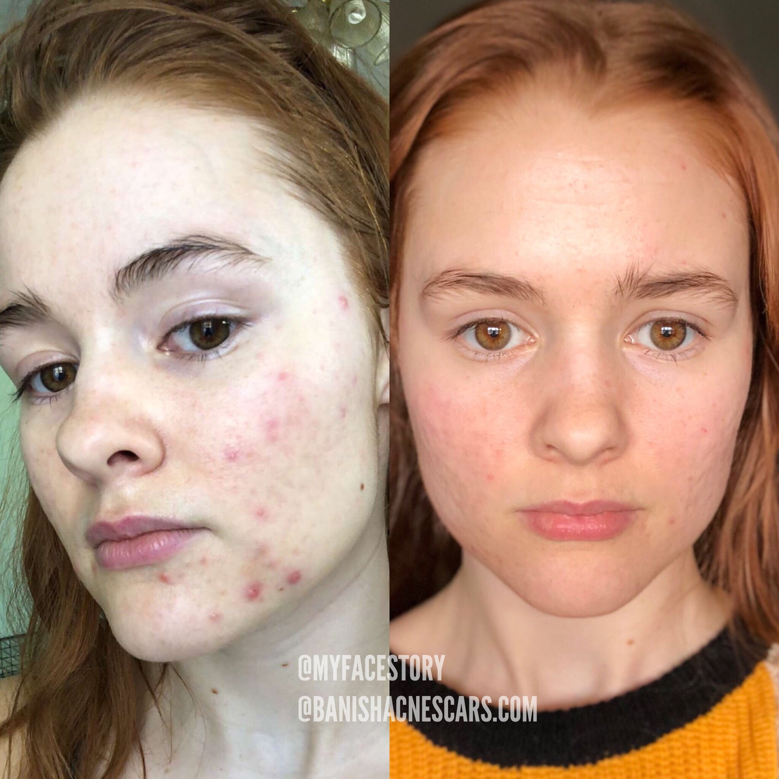 can juicing give you acne
