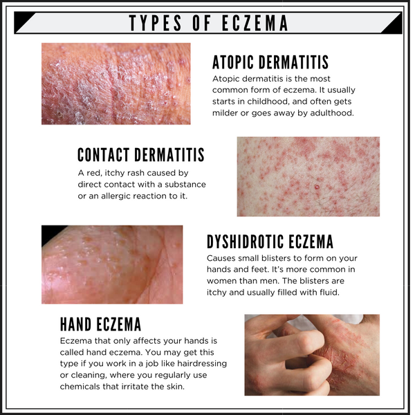 types of eczema