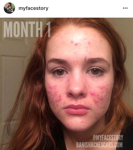 accutane month 1