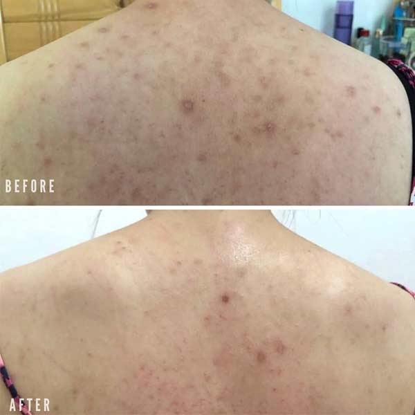 back acne scars before after banish kit