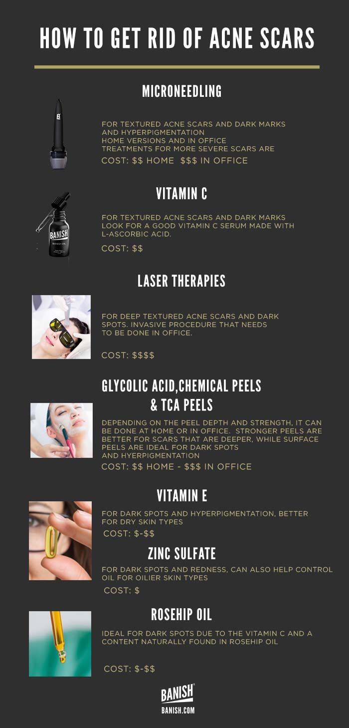 how to get rid of acne scars infographic banish