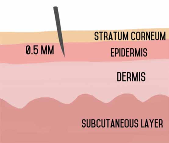 microneedling drawing epidermis level 0.5mm