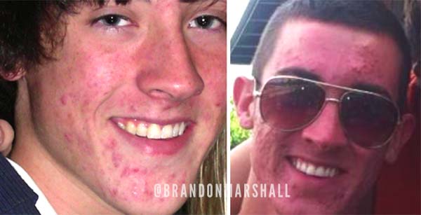 brandon banish acne