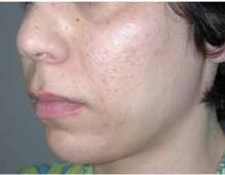 hyperpigmentation