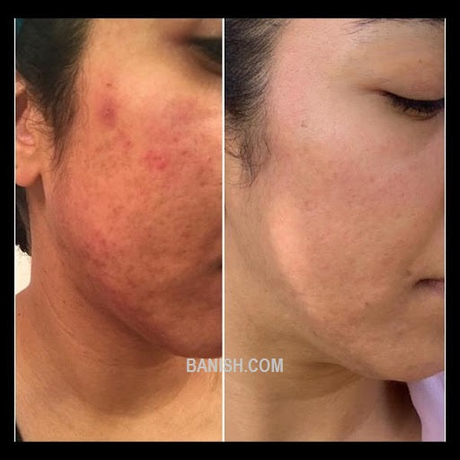 before and after results of right cheek