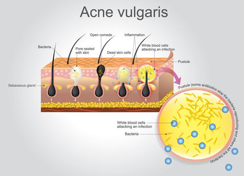 Acne Type Skin Sensitivity. 
