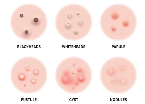 Different Types Of Acne 