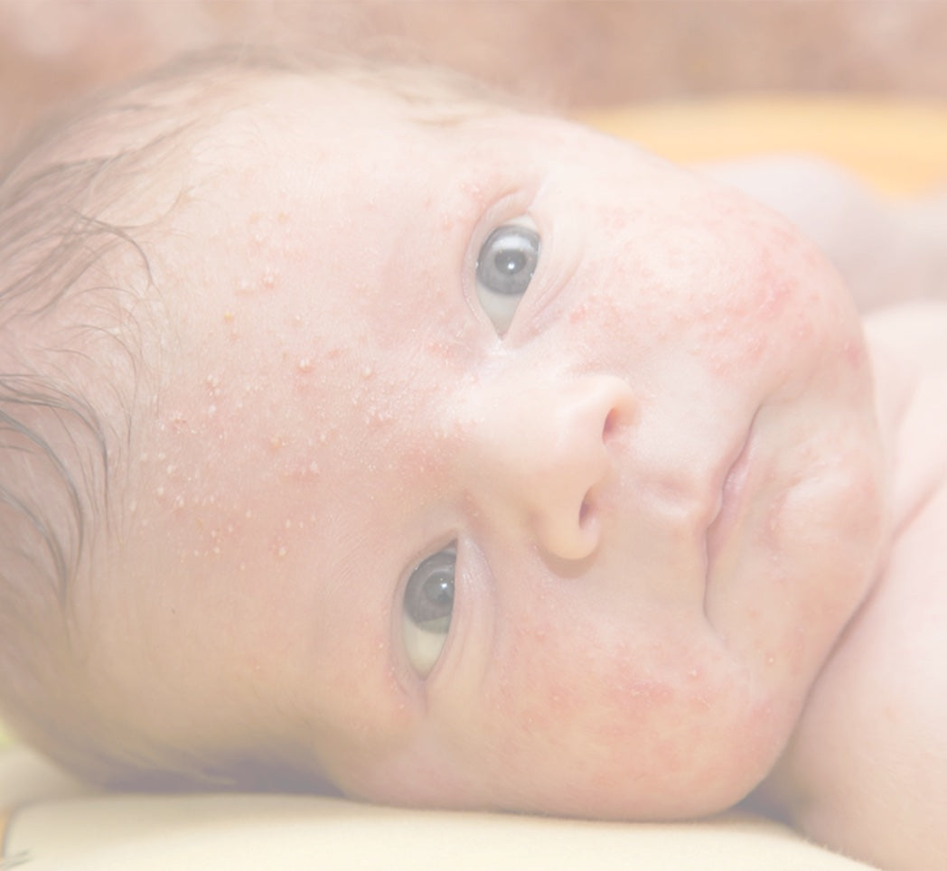 Gastvrijheid spek Immigratie Baby Acne Vs. Rash: How To Tell The Difference