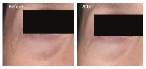 Undereye treatment with best skincare topical for skin luminosity