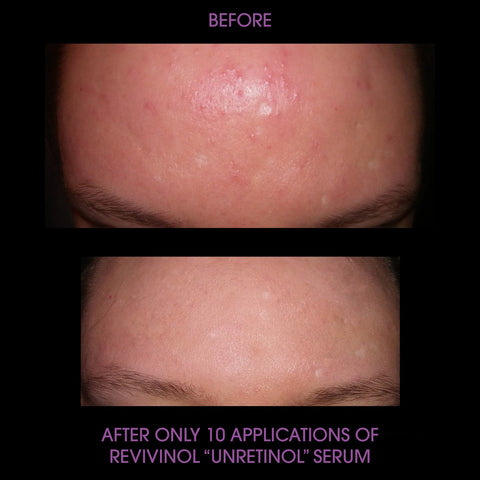 Before and after photos of alt-Retinol product cheaper bigger better than Biossance Squalane + Phyto-Retinol Serum