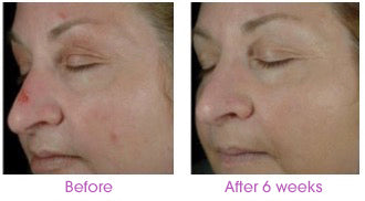 Before and after Sytenol, the remarkable component of Revivinol Serum