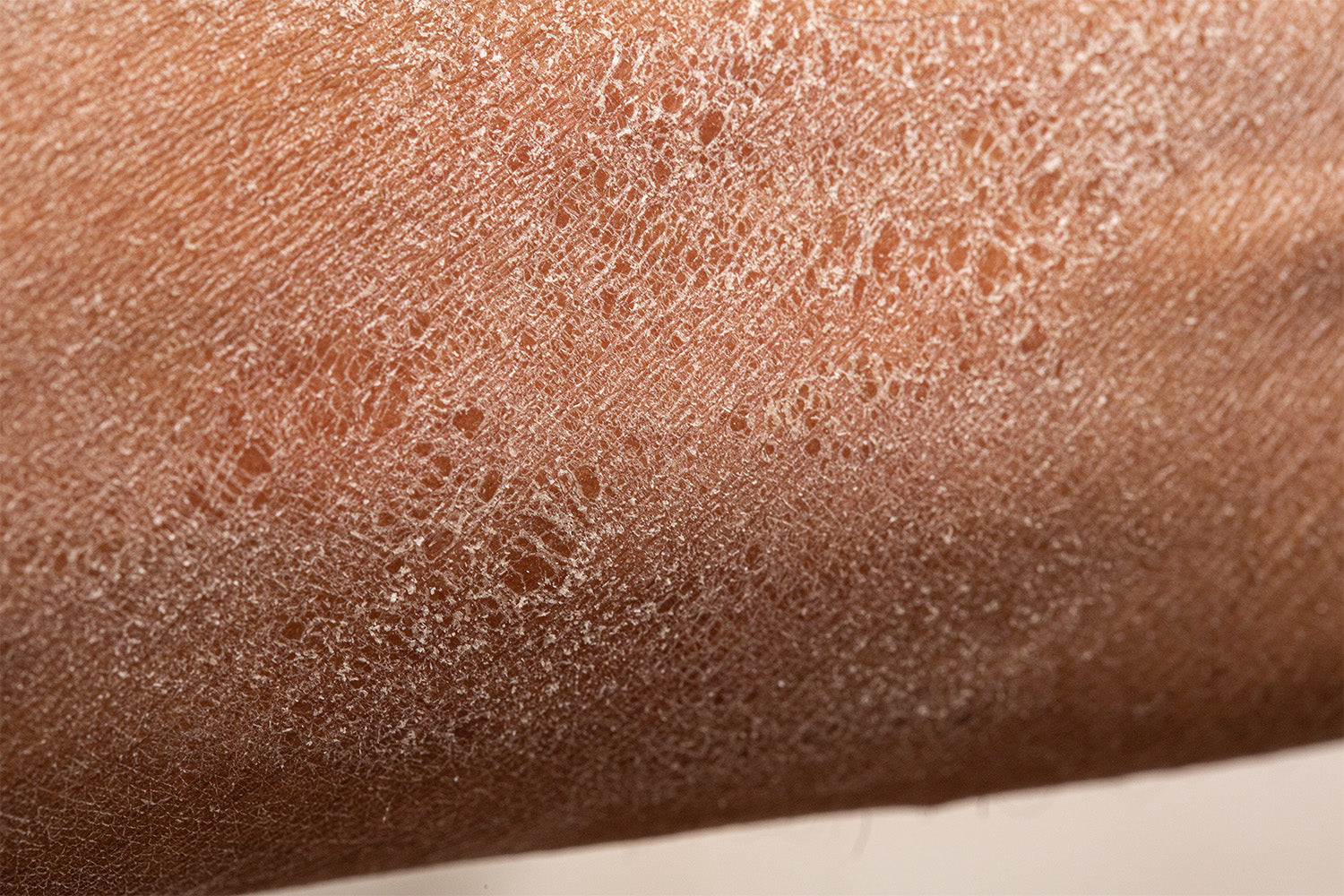 6 Causes of Dry Patches on Your & What To Do | iwi life