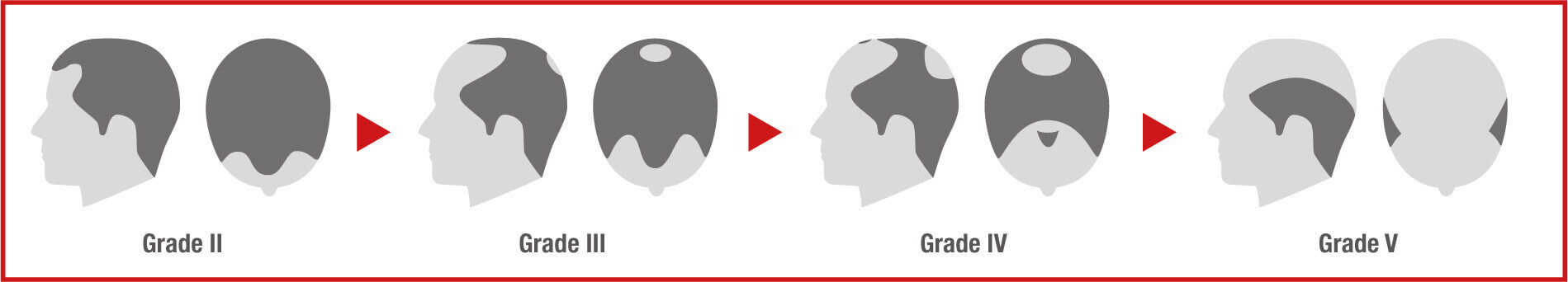 Hamilton-Norwood scale from stage 2 to 5