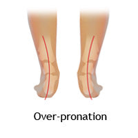 Over-pronation